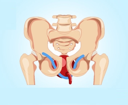 Vì sao hay có rối loạn tiết niệu sau mổ ung thư trực tràng